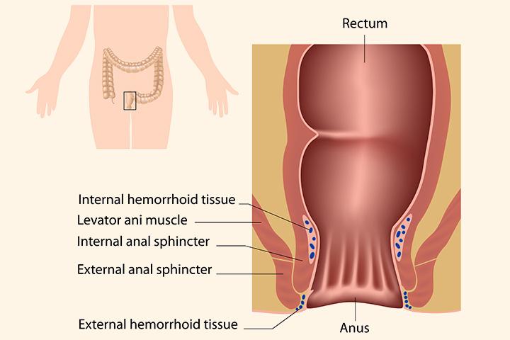 how can i treat my dogs hemorrhoids at home