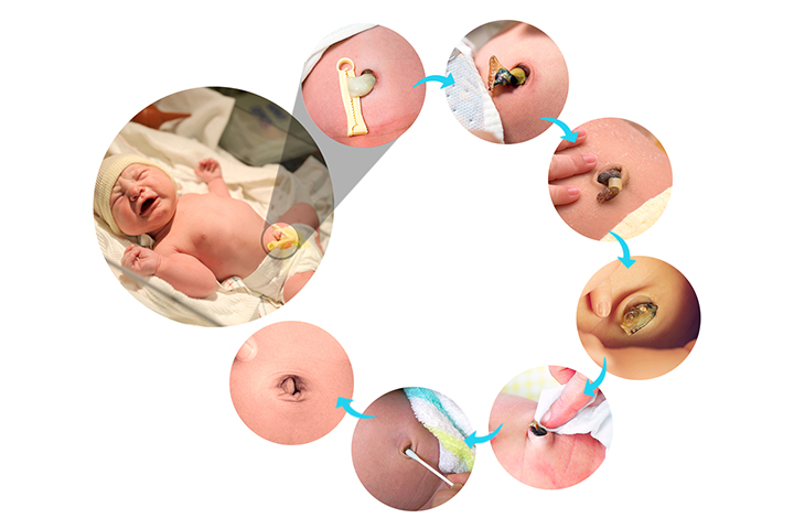 Caring for baby's umbilical stump