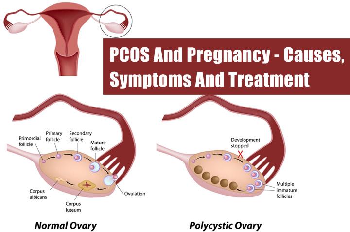 what-is-pcos-causes-symptoms-treatment