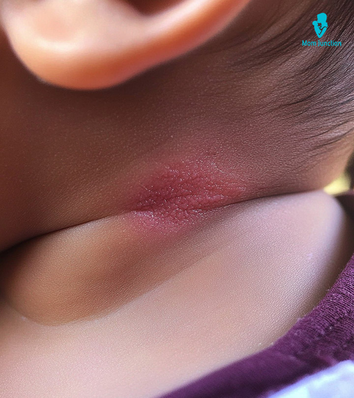 A Baby With Neck Rash