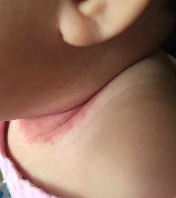 Woke up to find a rash on my breast.. what's causing this? : r