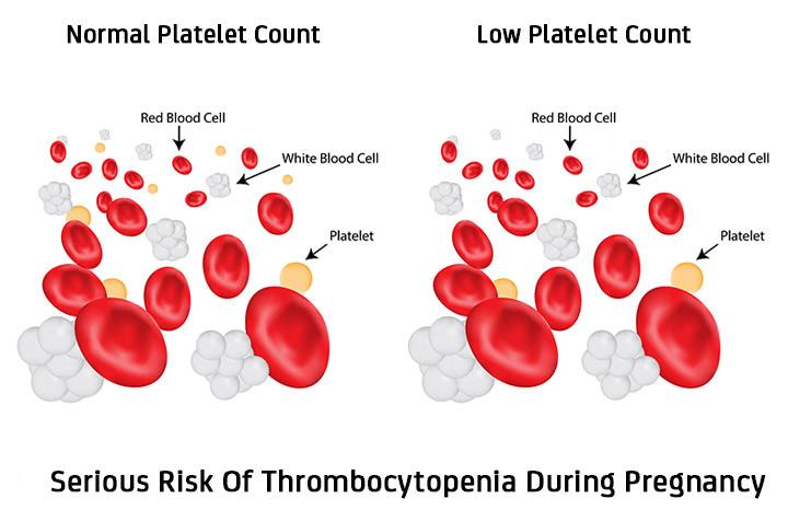 Thrombocytopenia Low Platelets In Pregnancy Causes Risks And Treatment