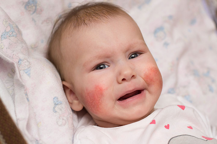 baby allergic reaction to detergent
