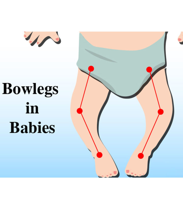 Bow Legged Baby: Causes, Symptoms, Treatment And Prevention