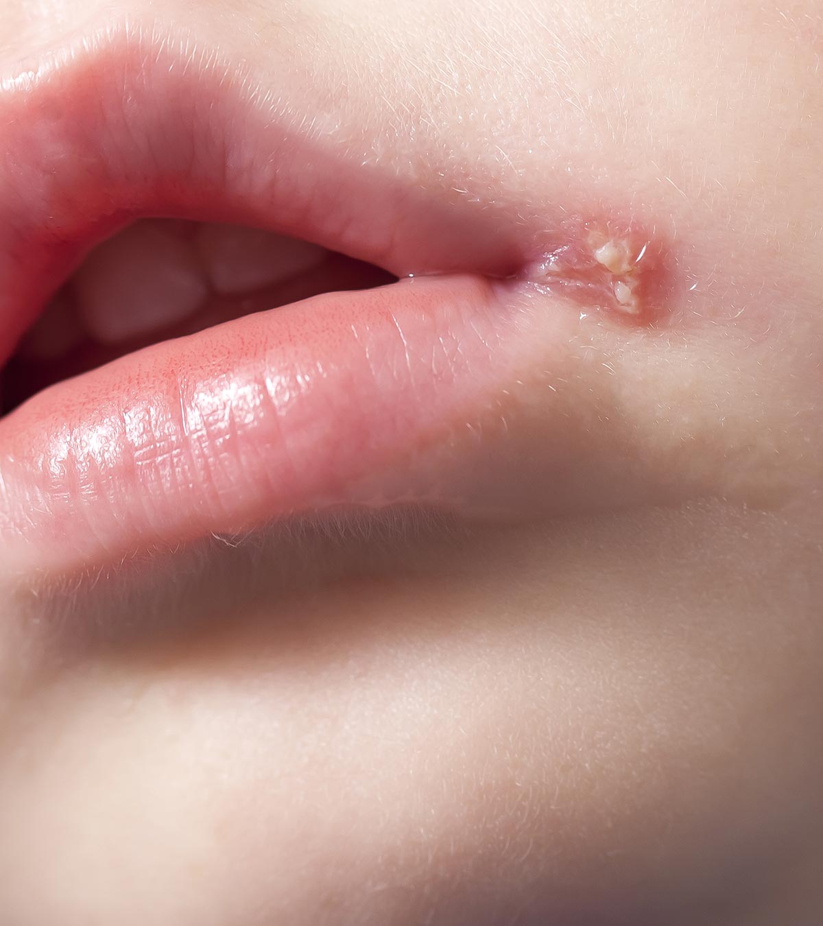 Baby With Cold Sores On Lips