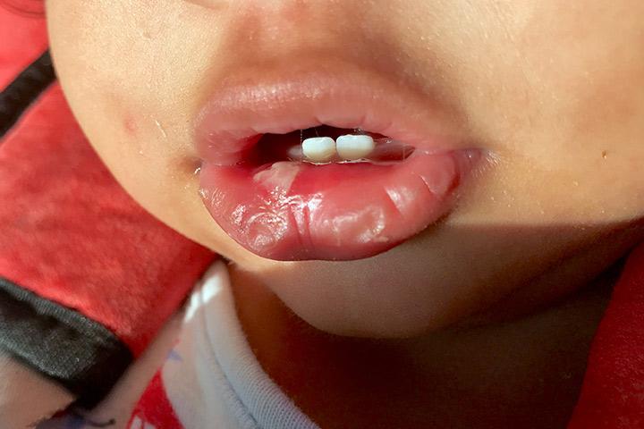 7 Effective Home Remedies To Prevent Baby s Mouth Ulcers