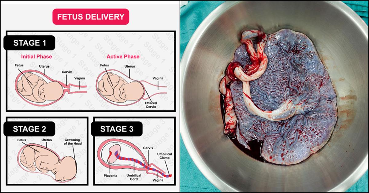 Retained Placenta Causes Symptoms And Treatment