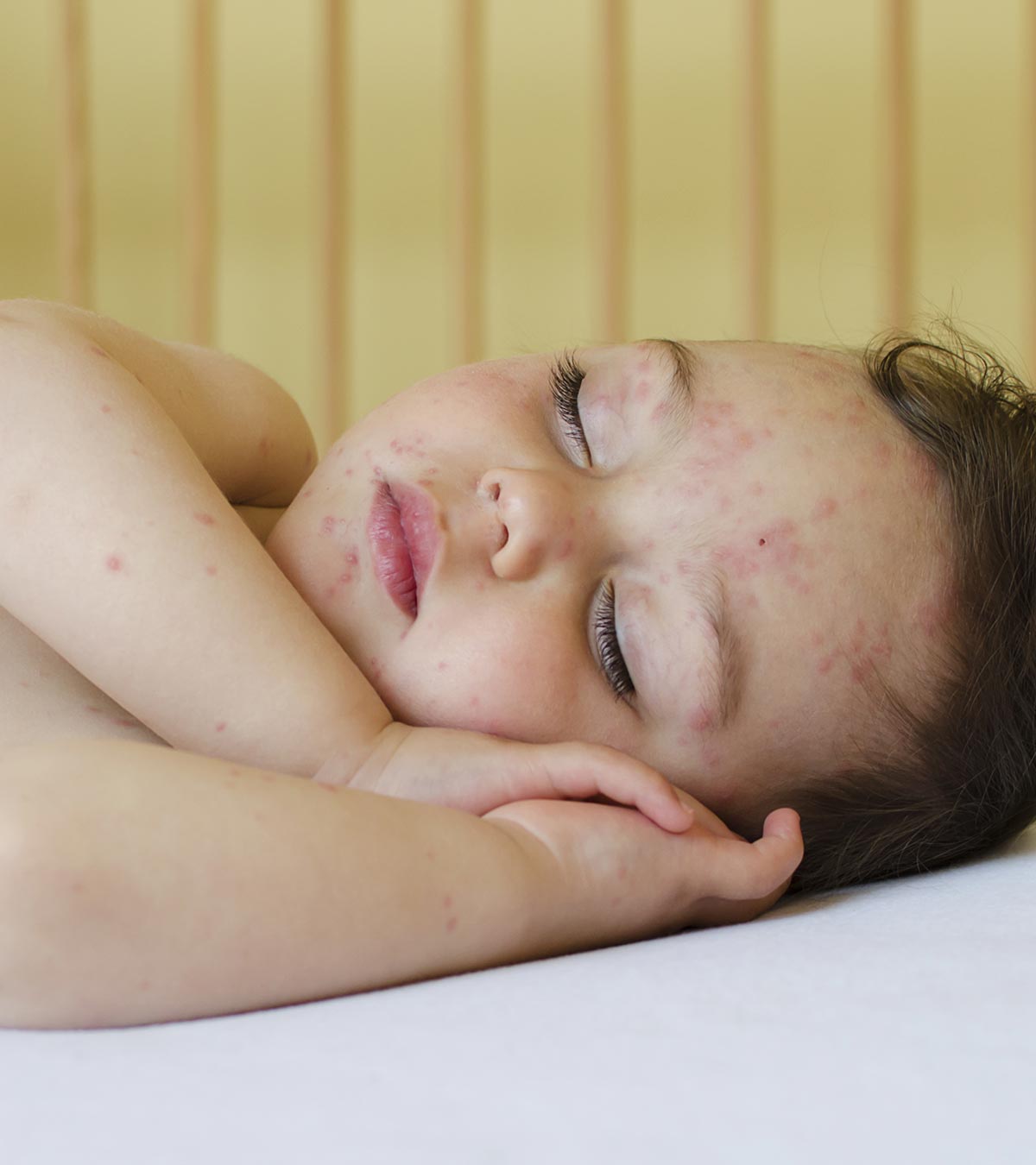 chicken pox in kids