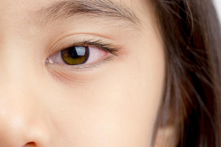 corneal-abrasion-in-children-causes-symptoms-and-treatment