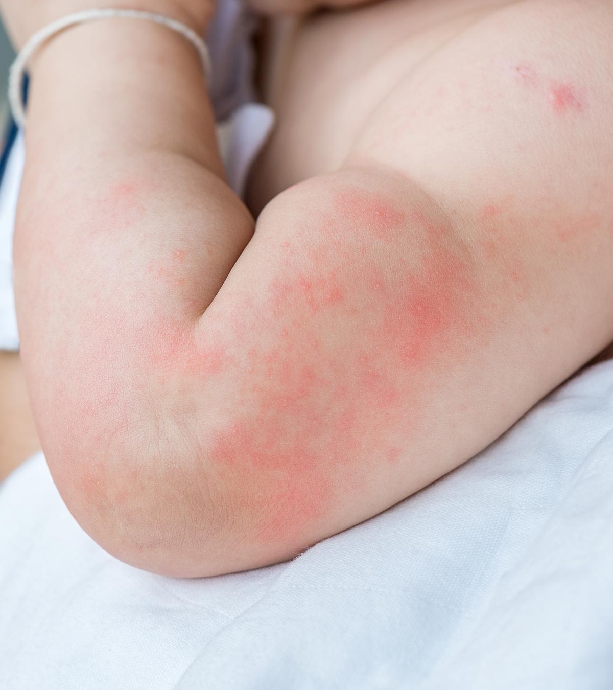 Hives In Babies