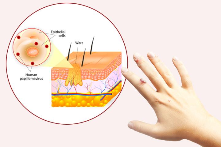 12-symptoms-and-effective-treatments-of-warts-in-children