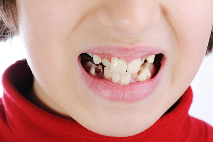 7 Causes Behind Discolored Teeth In Children And Treatment