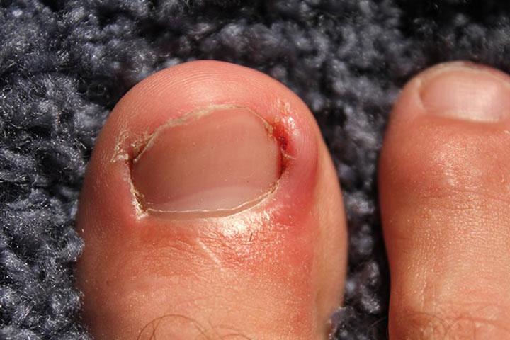 Ingrown Toenail In Children 6 Causes And 7 Treatments