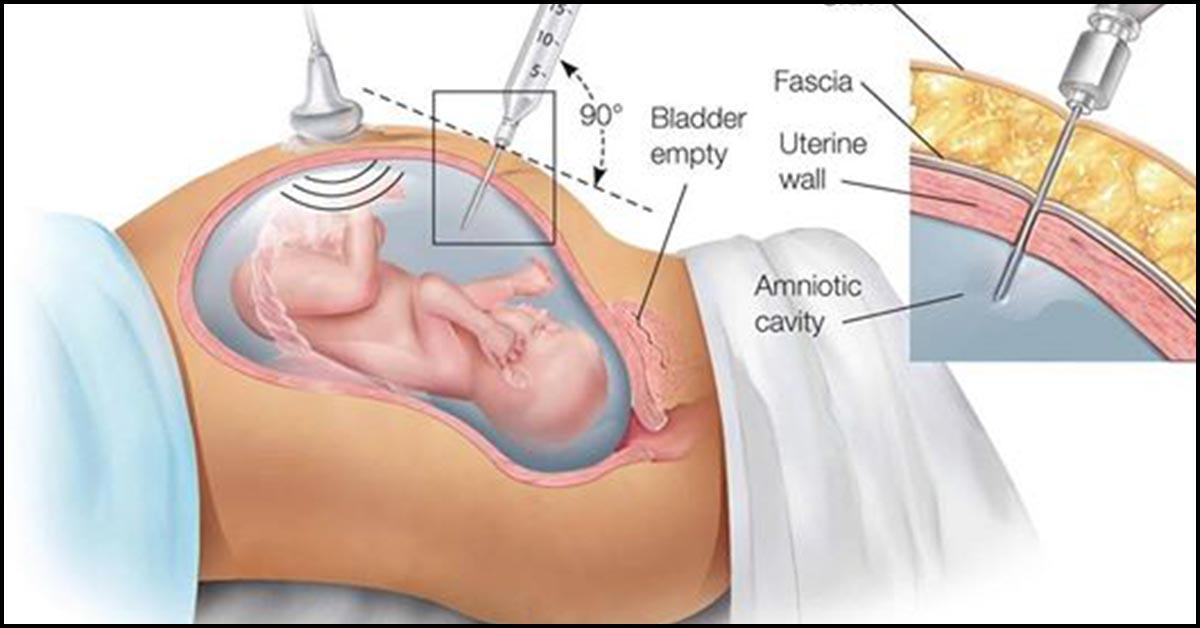 Leaking Amniotic Fluid Signs Causes And Treatment