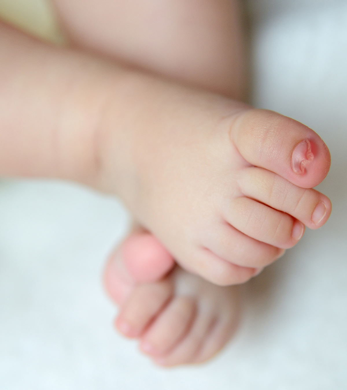 Baby's Ingrown Toenails: Causes 