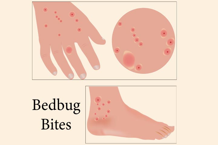 baby bed bug bites
