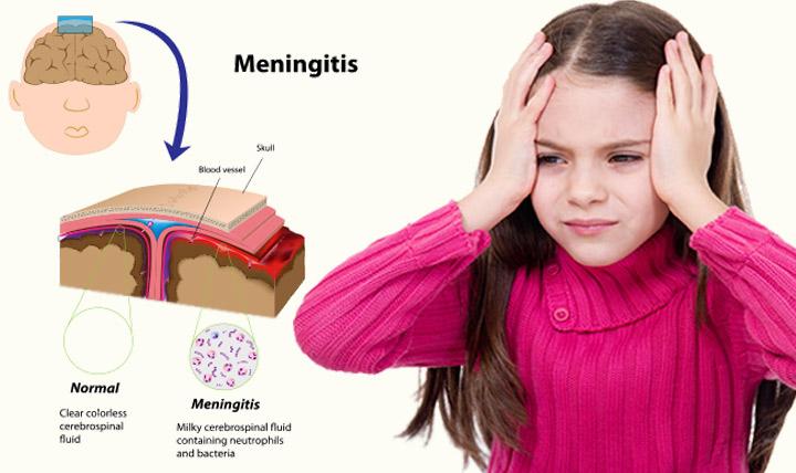 Meningitis In Children - Causes, Symptoms & Treatment