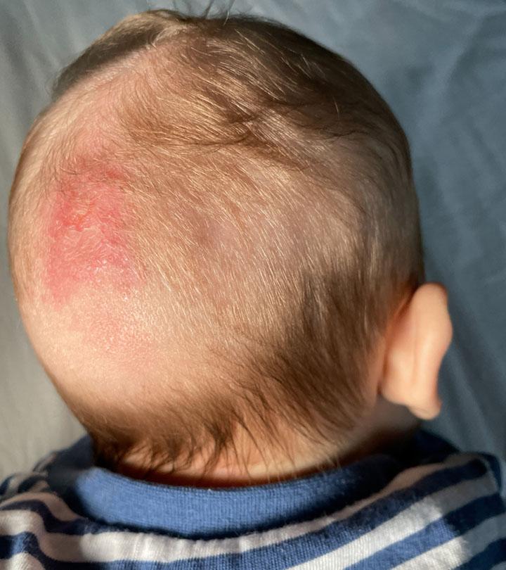 Fungal Infection In Babies Risks Treatment And Remedies