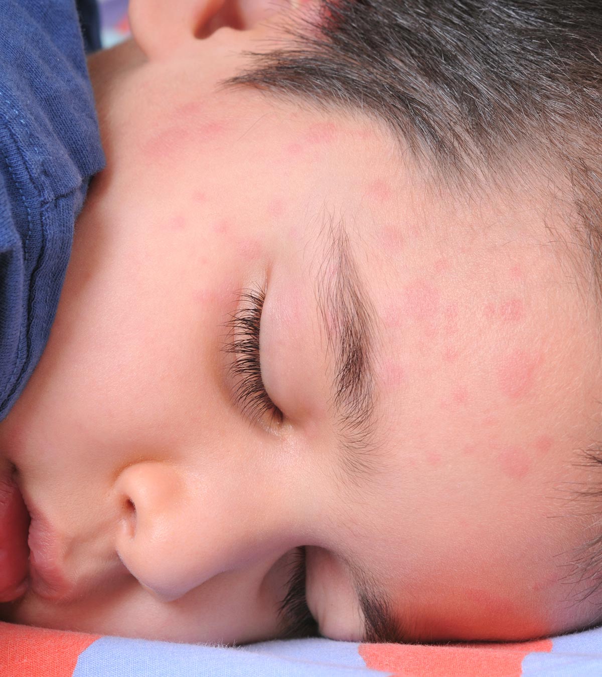 Child With Hives