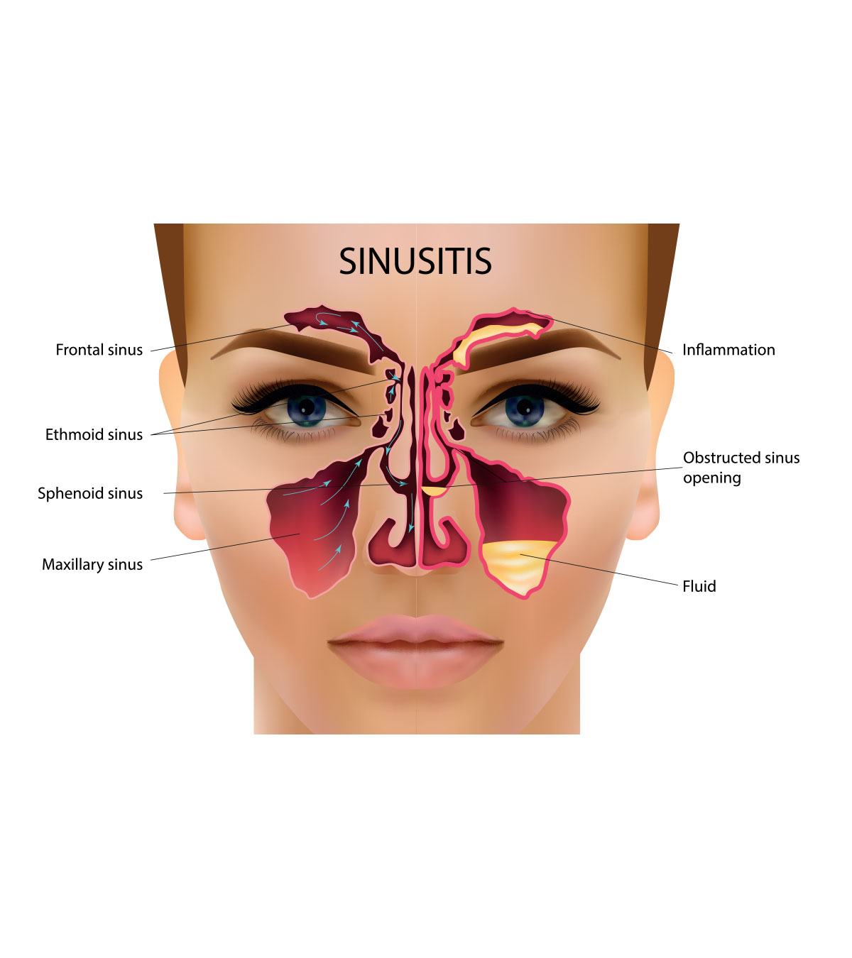 sinus infection antibiotics