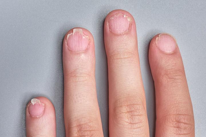 Hand Nail Fungus