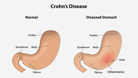 7 Unexpected Symptoms Of Crohn
