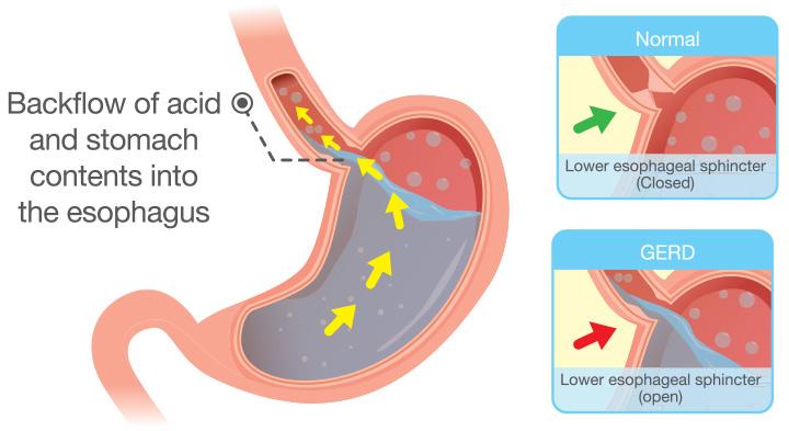 acid-reflux-in-babies-causes-symptoms-and-treatment