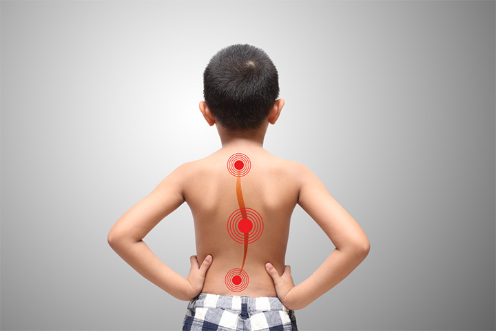 13 Causes Of Back Pain In Teens, Treatment & When To Worry