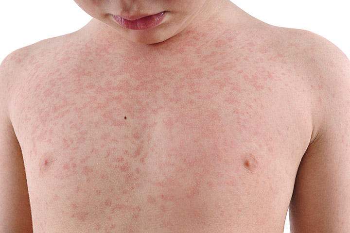 https://www.momjunction.com/wp-content/uploads/2015/12/Measles-1.jpg