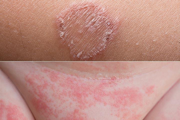 What Cause Rashes In Babies And How To Prevent Them 