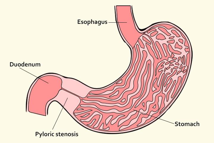 Pyloric Stenosis: Causes, Symptoms And Treatment