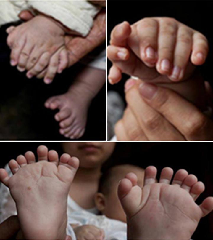 Baby Born With 31 Fingers And Toes In China