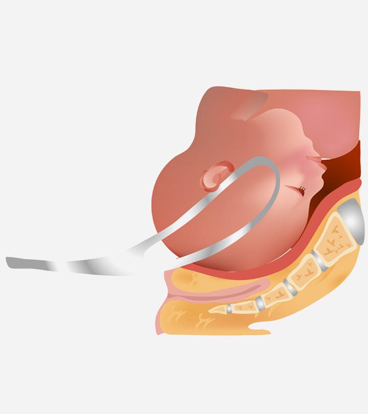 What Are The Risks And Benefits Of A Forceps Assisted Birth