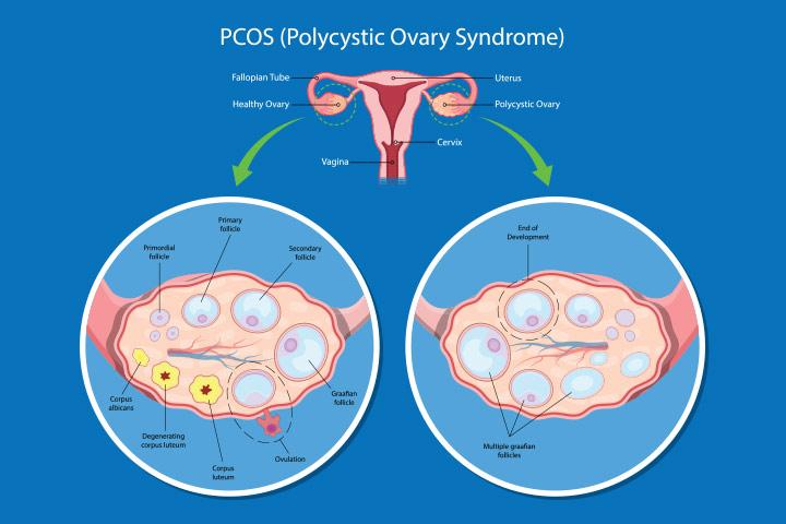 pcos-pcod-pcod-ke-gharelu-upchar