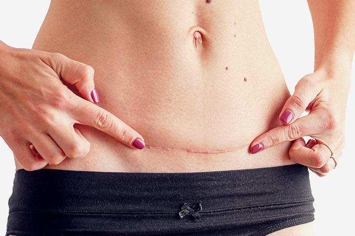 c-section-scar-infection-causes-types-signs-and-treatment