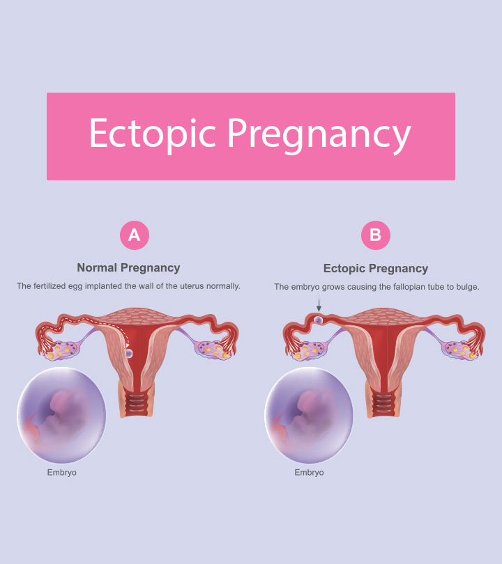Ectopic Pregnancy Causes Symptoms Treatment And Risks Momjunction