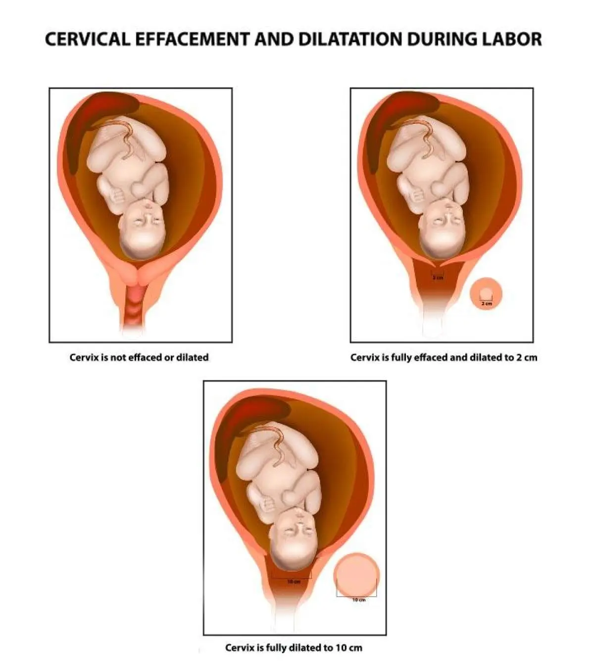 Cervix Dilation Chart Signs Stages And Procedure To Check