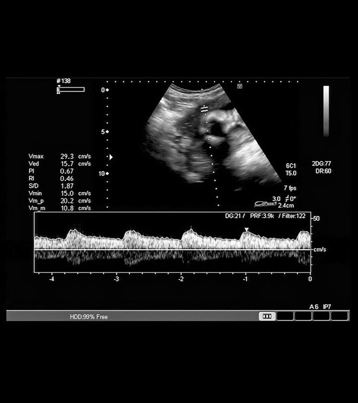 Fetal Heart Rate Monitoring Explained CardiacDirect 40 OFF