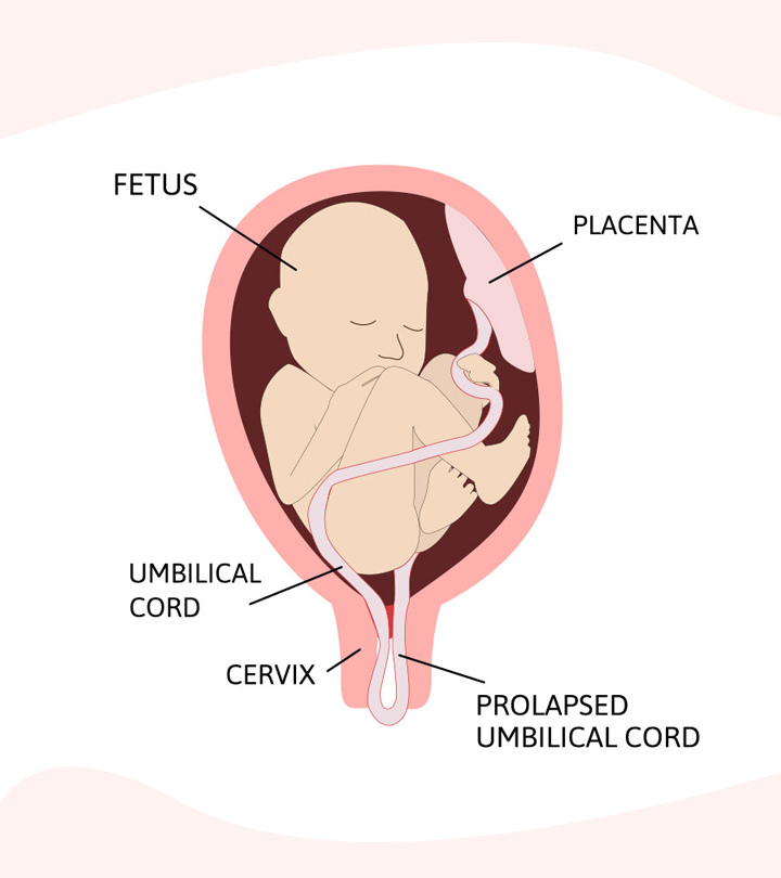 What Are the Elementary Causes and Symptoms of Uterus Prolapse