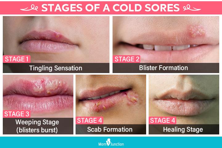 How Common Are Cold Sores Fever Blisters During Pregnancy 