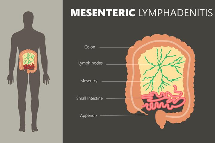 what-causes-mesenteric-panniculitis-how-is-it-treated