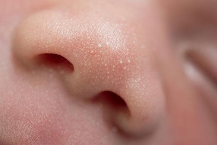 White Spots On A Child s Face Causes Remedies Treatment