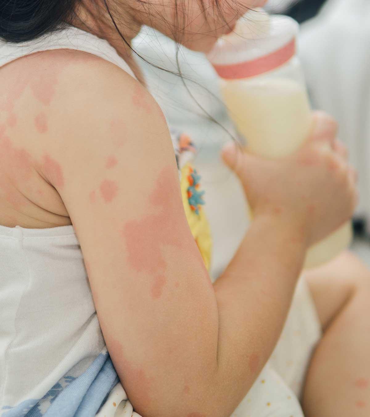 6 Signs And Symptoms Of Milk Allergy In Kids