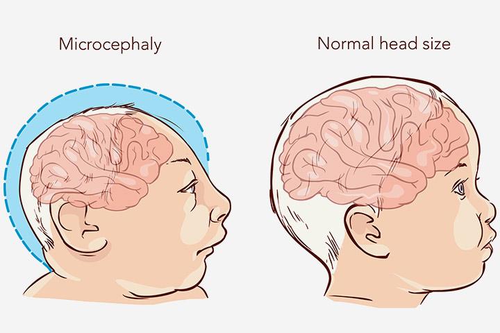 Microcephaly In Babies: Causes, Symptoms And Treatment