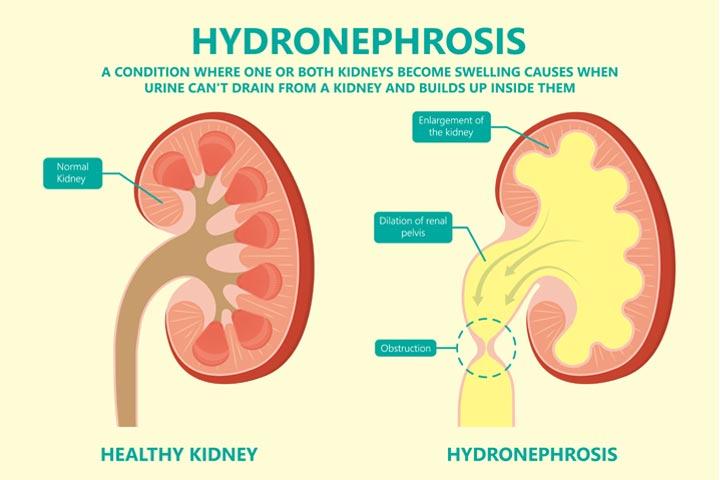 Hydronephrosis In Babies: Causes, Symptoms, And Treatment