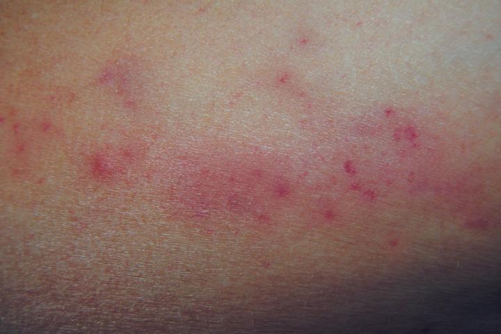 petechiae-causes