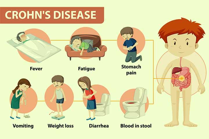 Crohn's Disease as related to Dietary Fats - Pictures