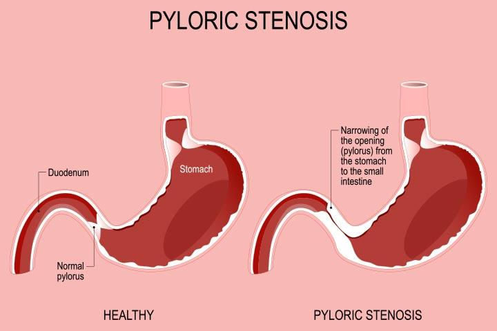 pyloric-stenosis-in-babies-symptoms-causes-and-treatment