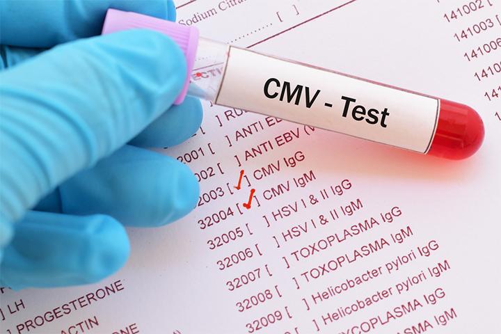 CMV (Cytomegalovirus) In Babies: Causes, Symptoms & Treatment ...