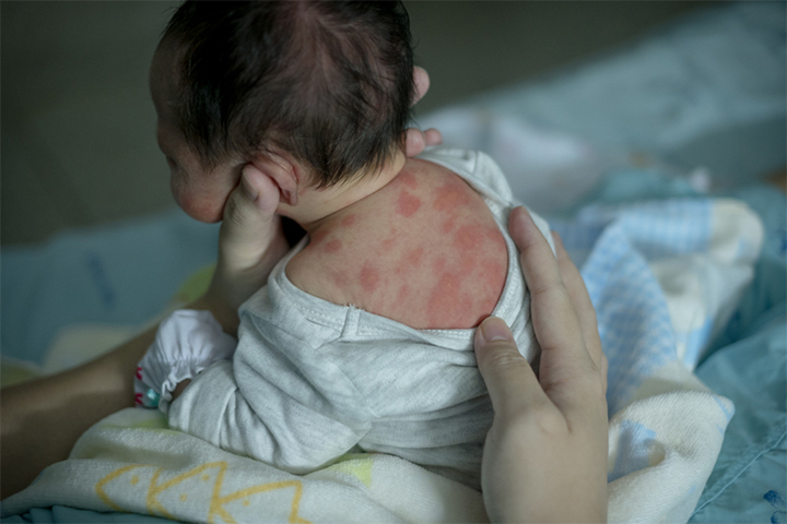 Erythema Toxicum In Newborns: Causes, Symptoms And ...